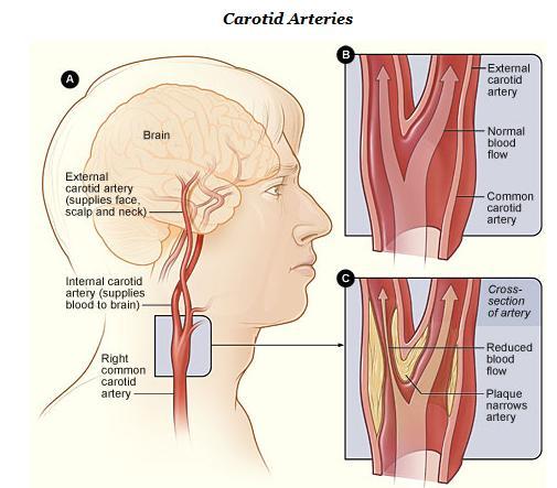 Carotid Arteries